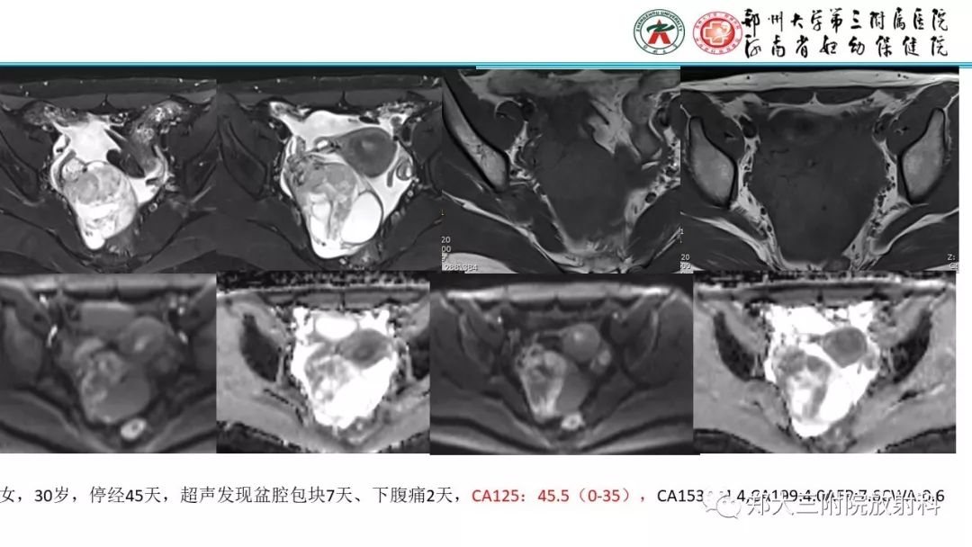 【病例】卵巢颗粒细胞瘤1例MR影像