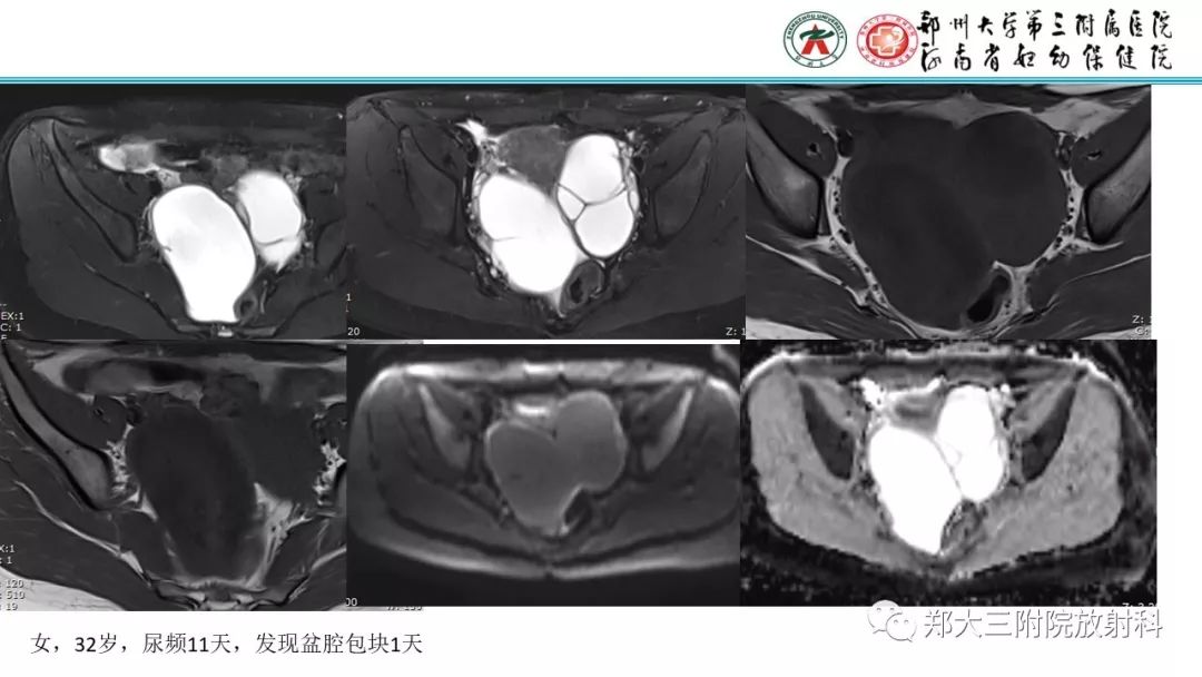 【病例】卵巢颗粒细胞瘤1例MR影像