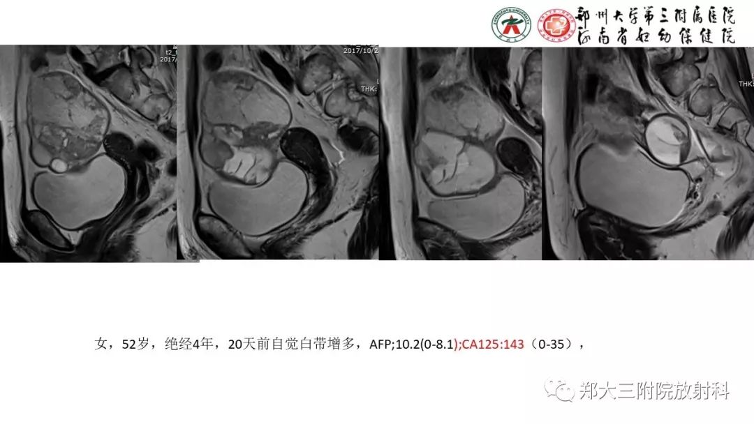 【病例】卵巢颗粒细胞瘤1例MR影像