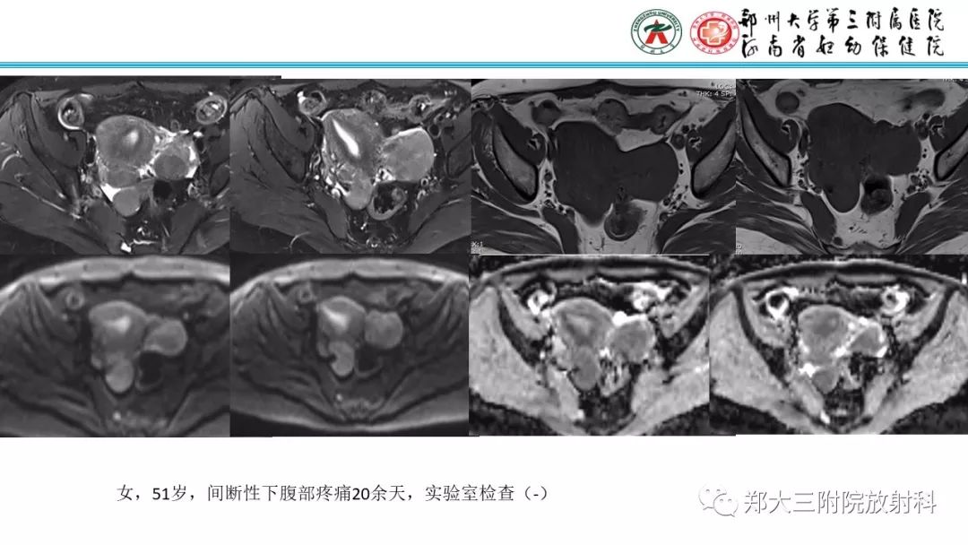 【病例】卵巢颗粒细胞瘤1例MR影像