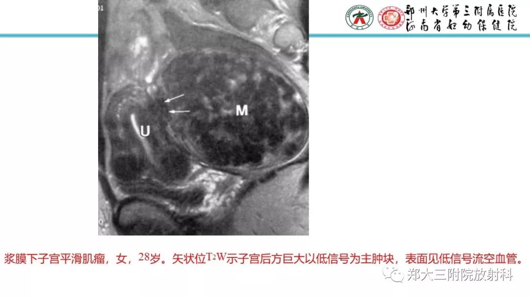 【病例】卵巢颗粒细胞瘤1例MR影像