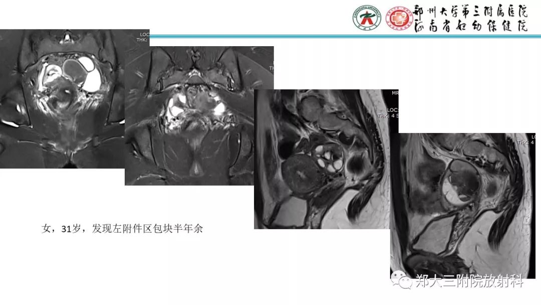【病例】卵巢颗粒细胞瘤1例MR影像