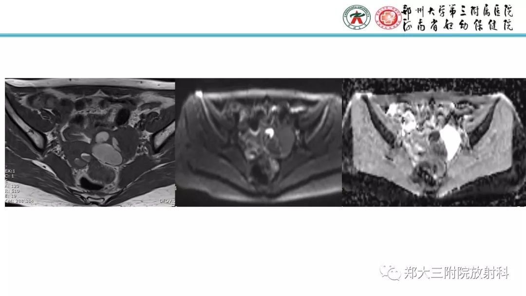 【病例】卵巢颗粒细胞瘤1例MR影像