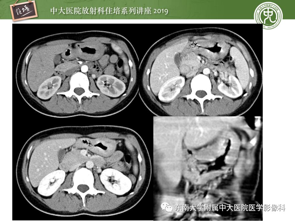 【PPT】“剑走偏锋”——胃肠道恶性肿瘤
