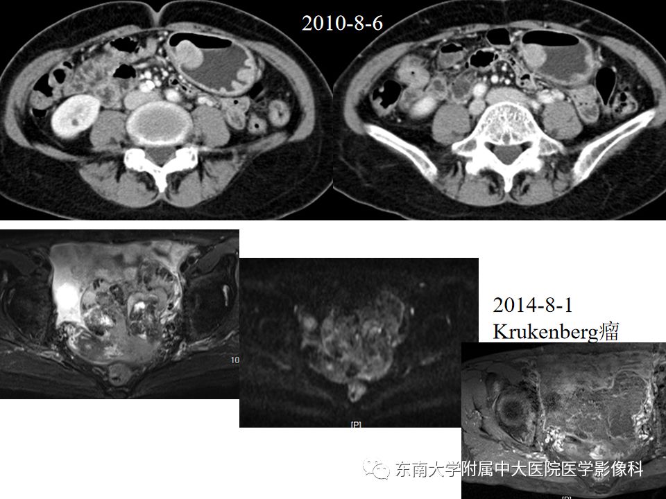 【PPT】“剑走偏锋”——胃肠道恶性肿瘤