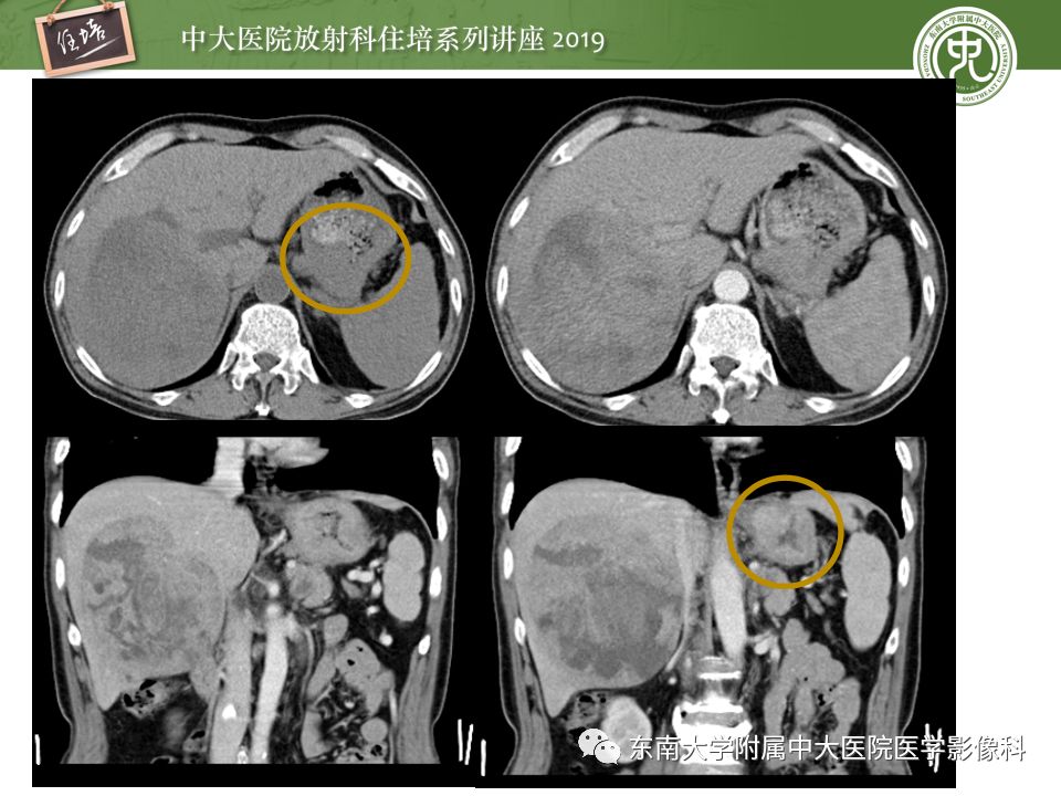 【PPT】“剑走偏锋”——胃肠道恶性肿瘤