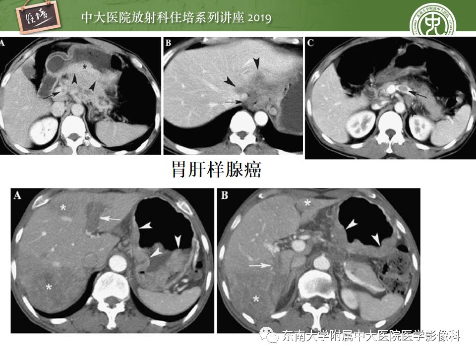 【PPT】“剑走偏锋”——胃肠道恶性肿瘤