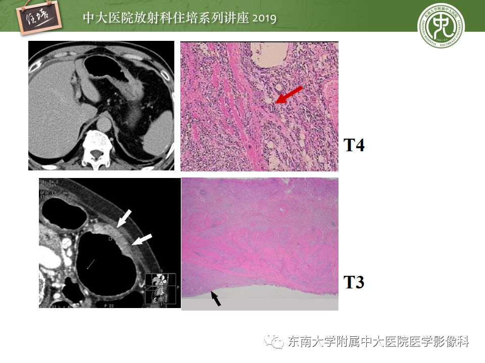 【PPT】“剑走偏锋”——胃肠道恶性肿瘤