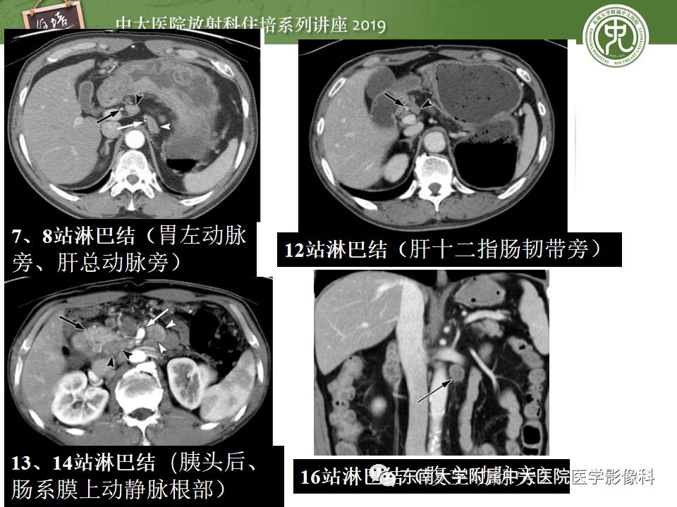 【PPT】“剑走偏锋”——胃肠道恶性肿瘤
