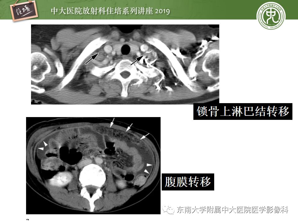 【PPT】“剑走偏锋”——胃肠道恶性肿瘤
