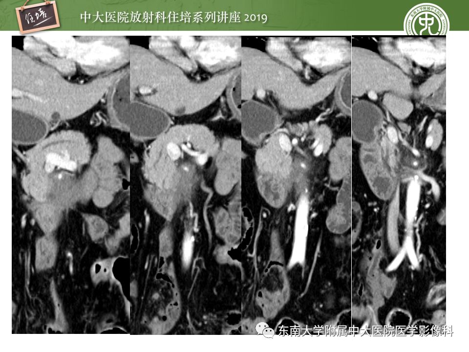 【PPT】“剑走偏锋”——胃肠道恶性肿瘤