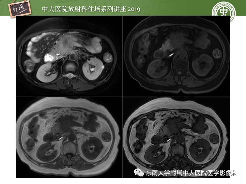 【PPT】“剑走偏锋”——胃肠道恶性肿瘤