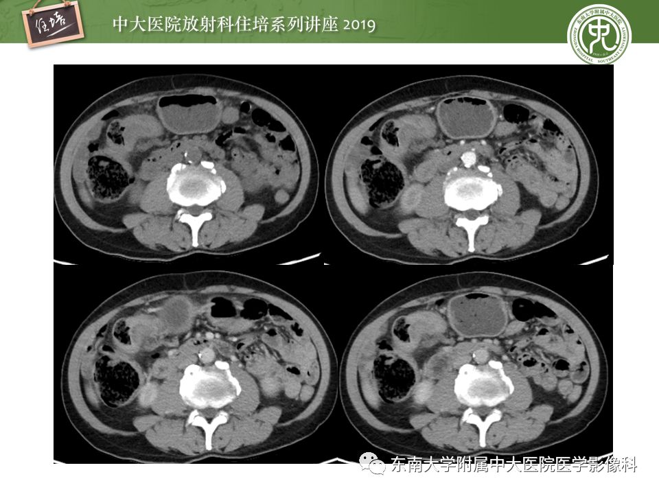 【PPT】“剑走偏锋”——胃肠道恶性肿瘤