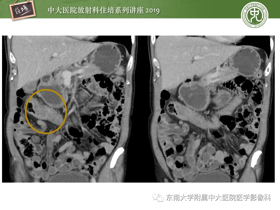 【PPT】“剑走偏锋”——胃肠道恶性肿瘤