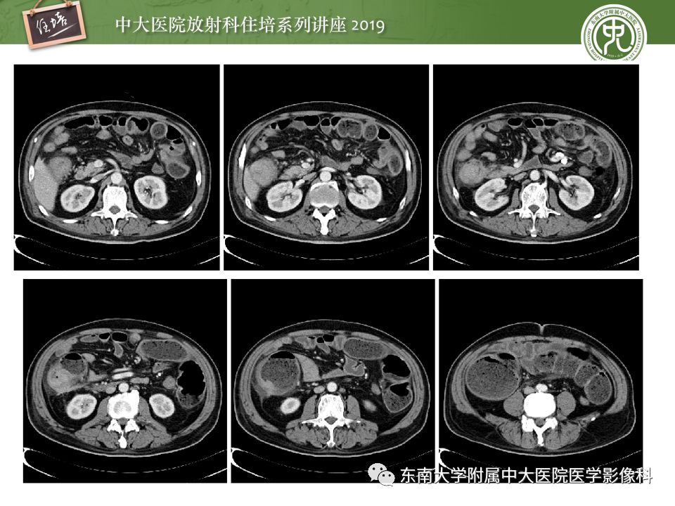 【PPT】“剑走偏锋”——胃肠道恶性肿瘤