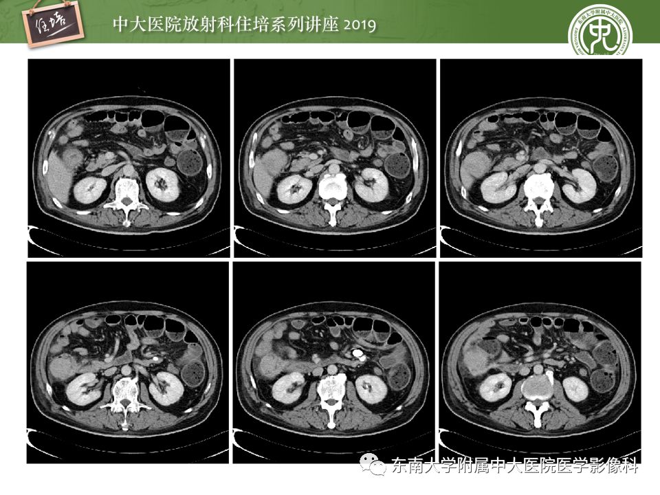 【PPT】“剑走偏锋”——胃肠道恶性肿瘤