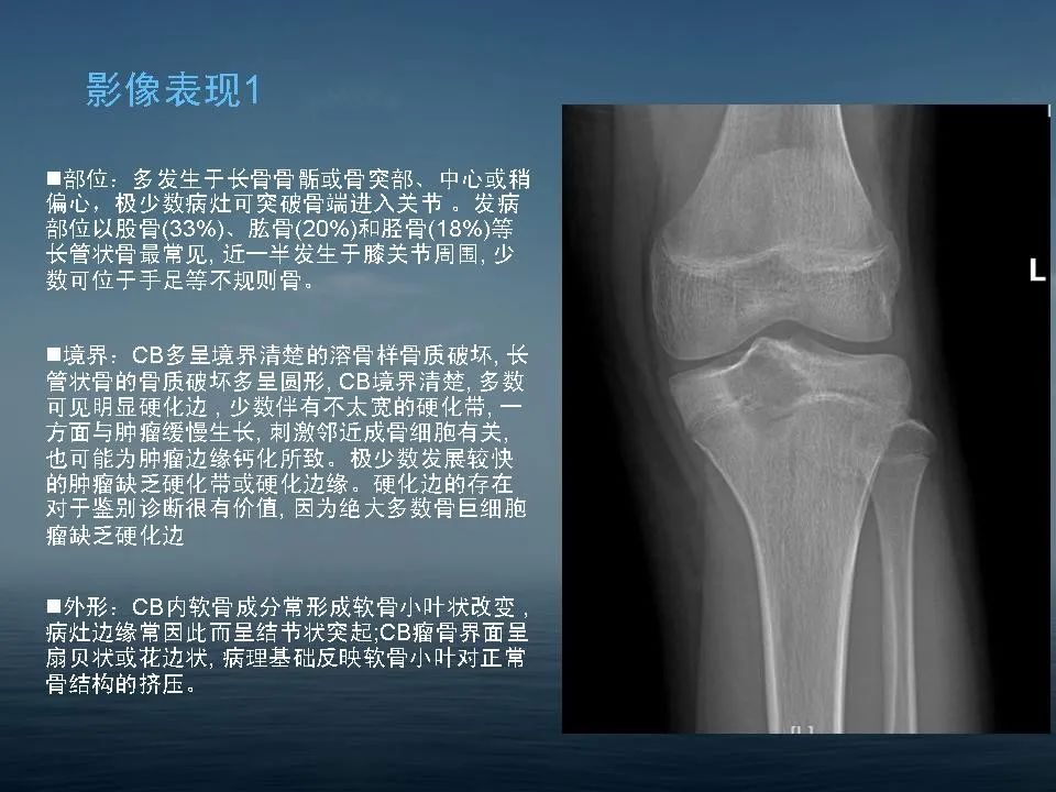 【PPT】软骨母细胞瘤的影像诊断