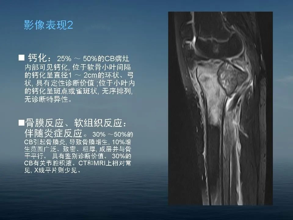 【PPT】软骨母细胞瘤的影像诊断
