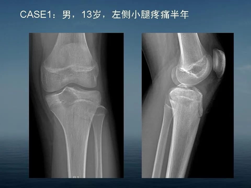 【PPT】软骨母细胞瘤的影像诊断