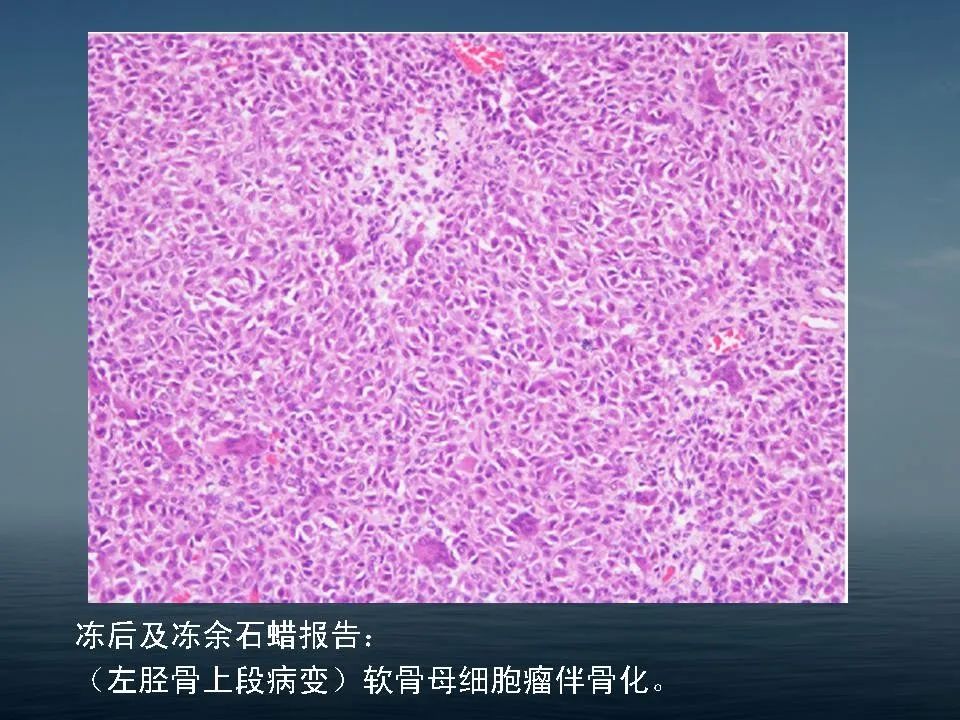 【PPT】软骨母细胞瘤的影像诊断