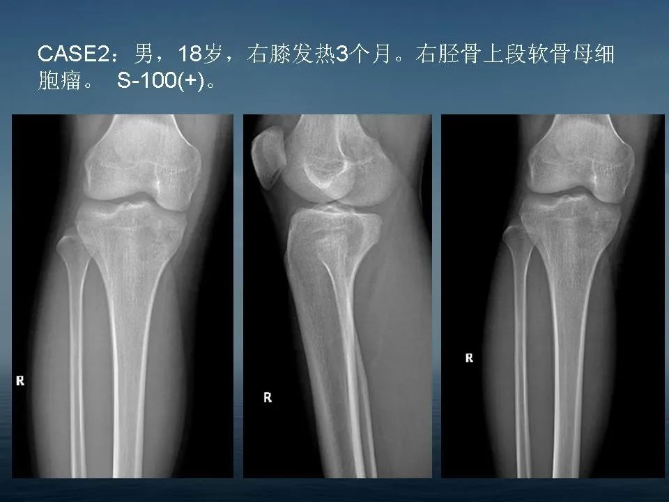 【PPT】软骨母细胞瘤的影像诊断