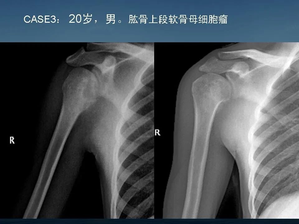 【PPT】软骨母细胞瘤的影像诊断