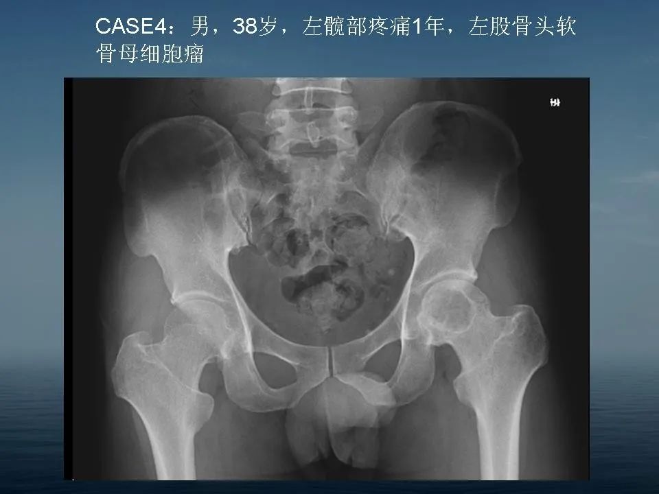 【PPT】软骨母细胞瘤的影像诊断