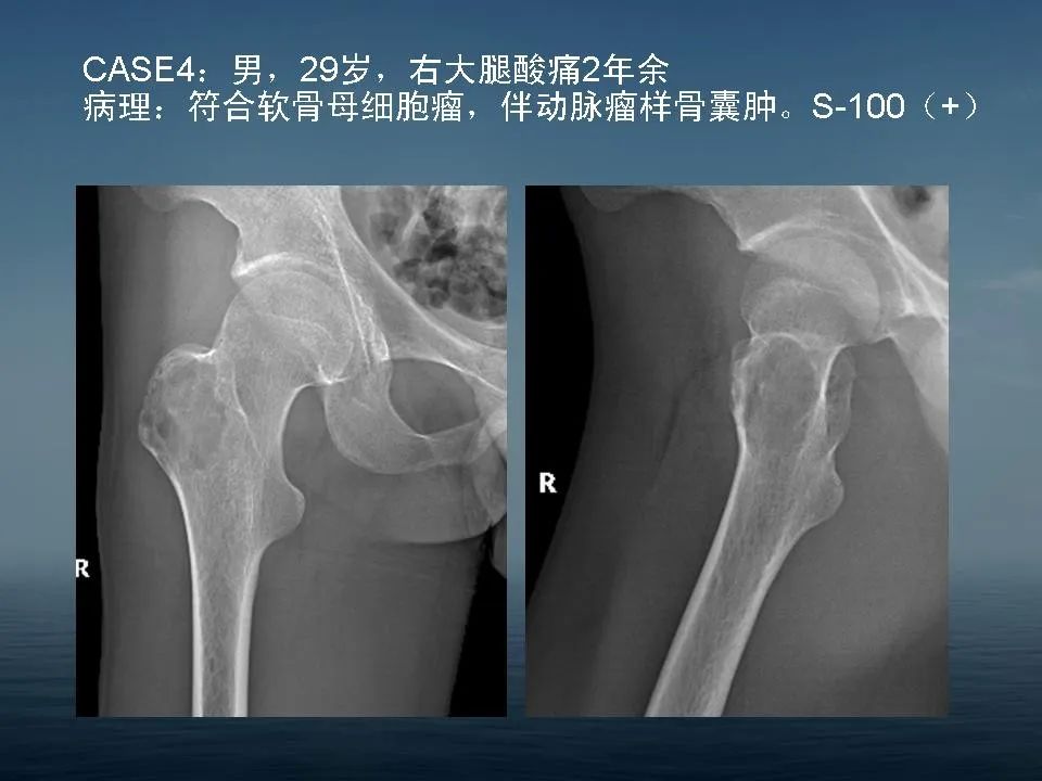 【PPT】软骨母细胞瘤的影像诊断