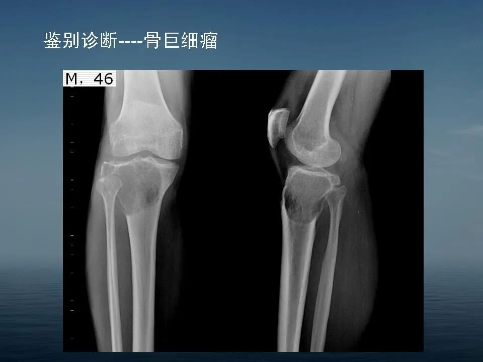 【PPT】软骨母细胞瘤的影像诊断