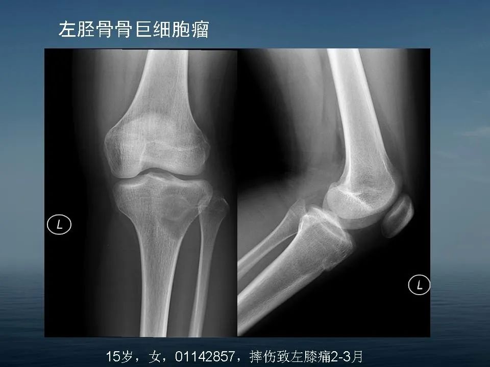 【PPT】软骨母细胞瘤的影像诊断