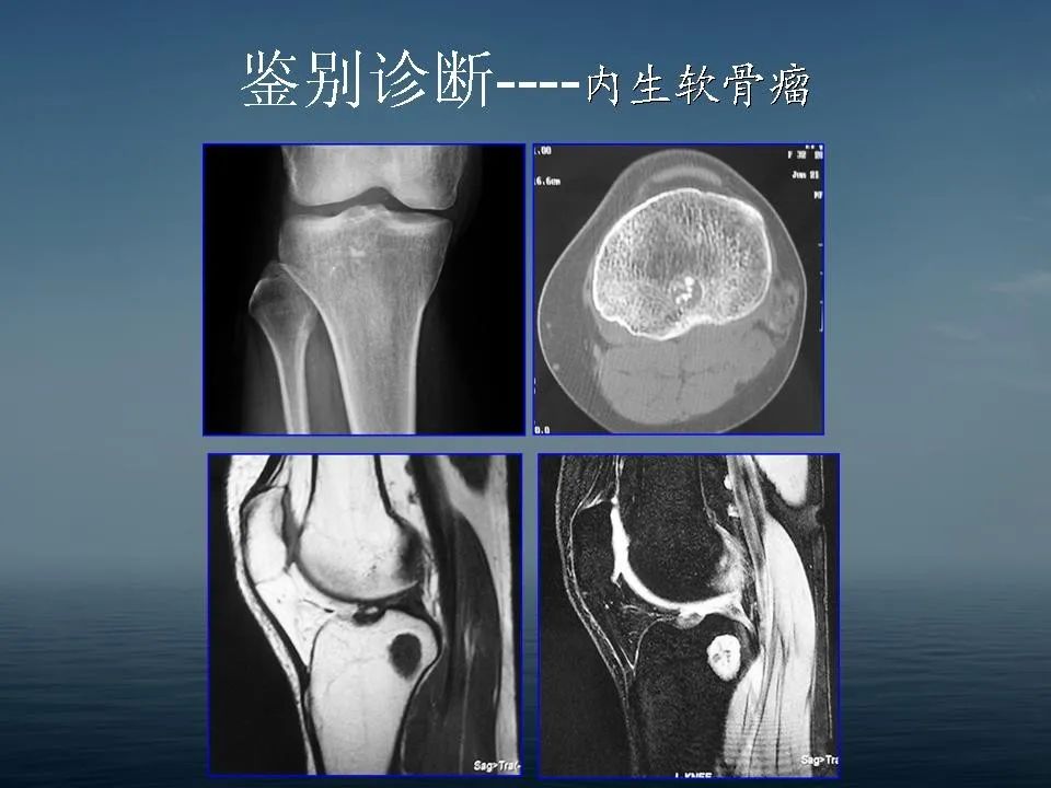 【PPT】软骨母细胞瘤的影像诊断