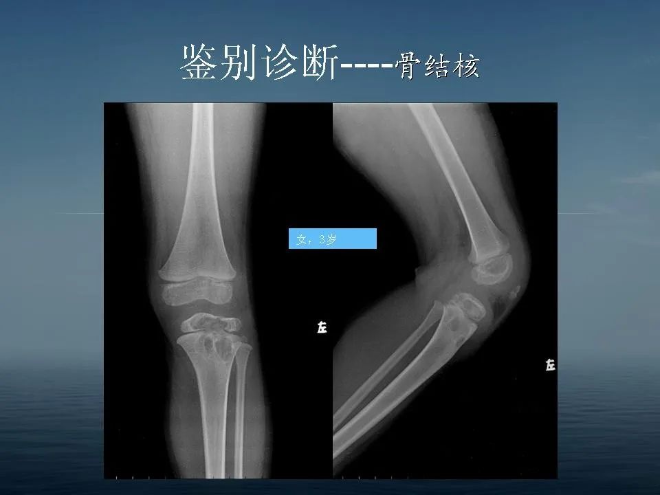 【PPT】软骨母细胞瘤的影像诊断