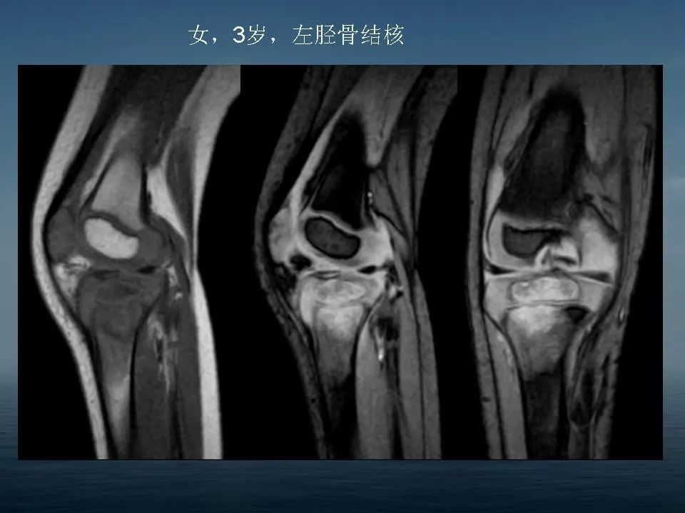 【PPT】软骨母细胞瘤的影像诊断
