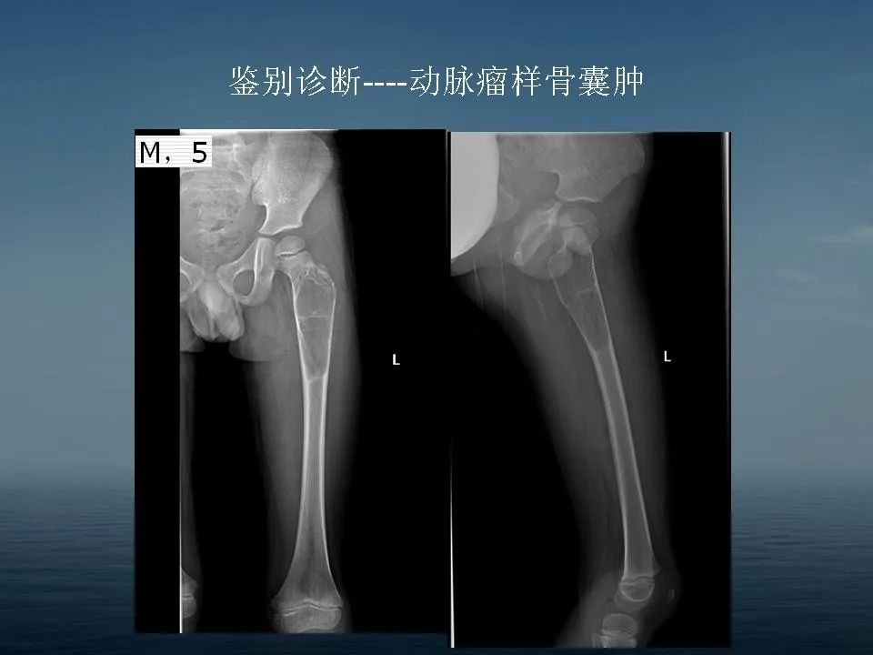 【PPT】软骨母细胞瘤的影像诊断