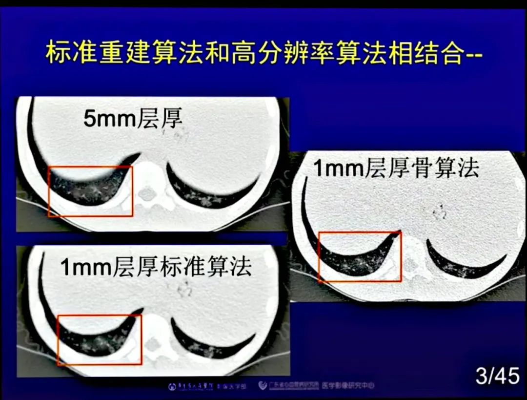 【PPT】新型冠状病毒感染CT早期诊断和鉴别诊断