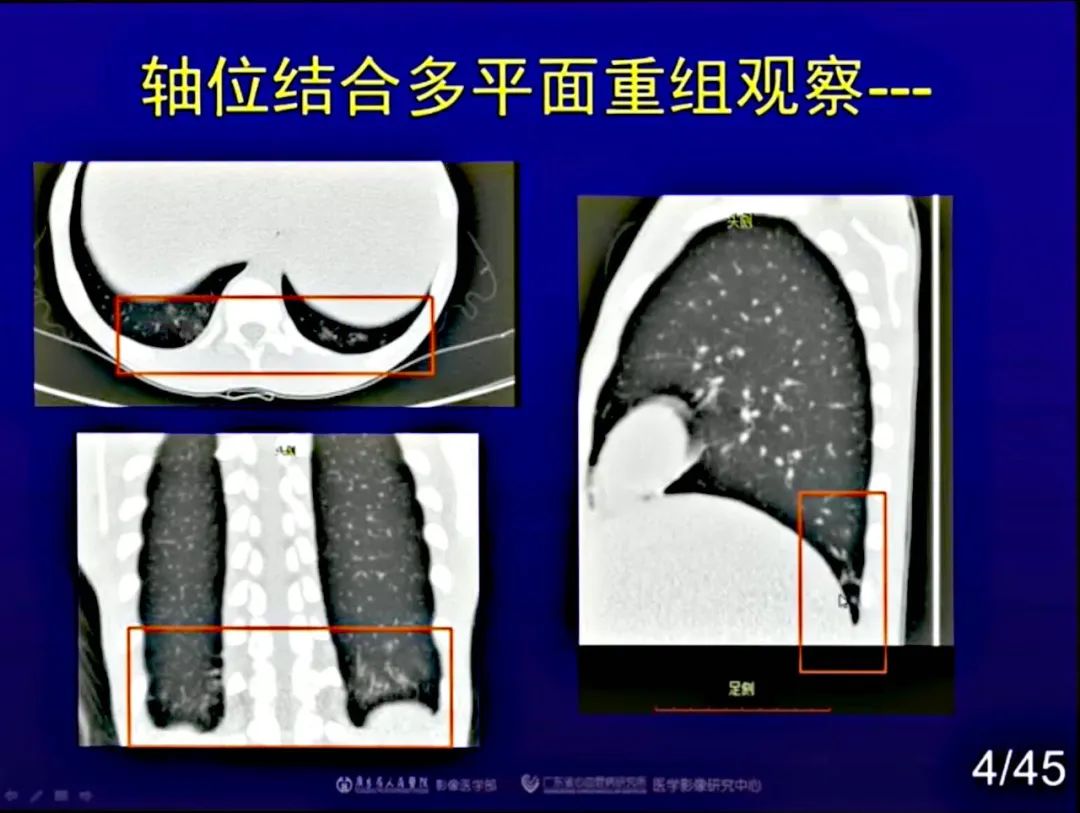 【PPT】新型冠状病毒感染CT早期诊断和鉴别诊断