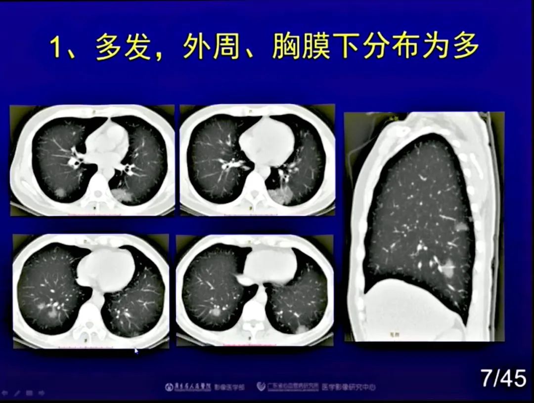 【PPT】新型冠状病毒感染CT早期诊断和鉴别诊断