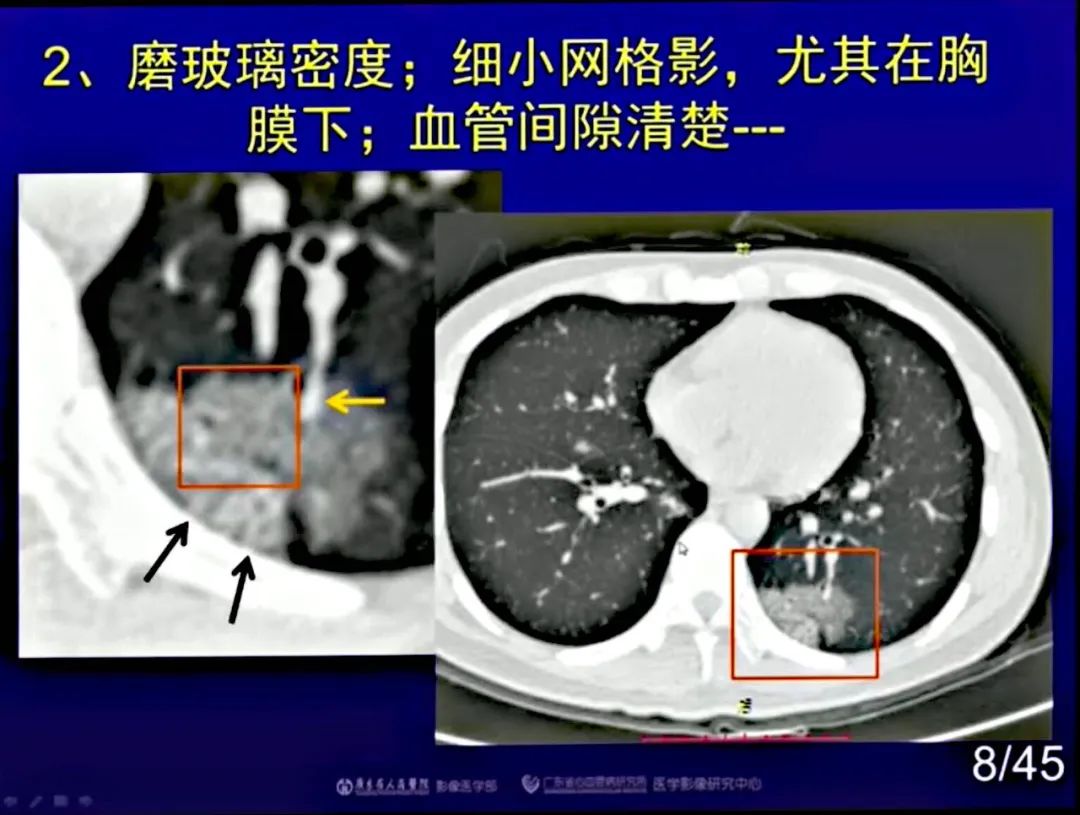 【PPT】新型冠状病毒感染CT早期诊断和鉴别诊断