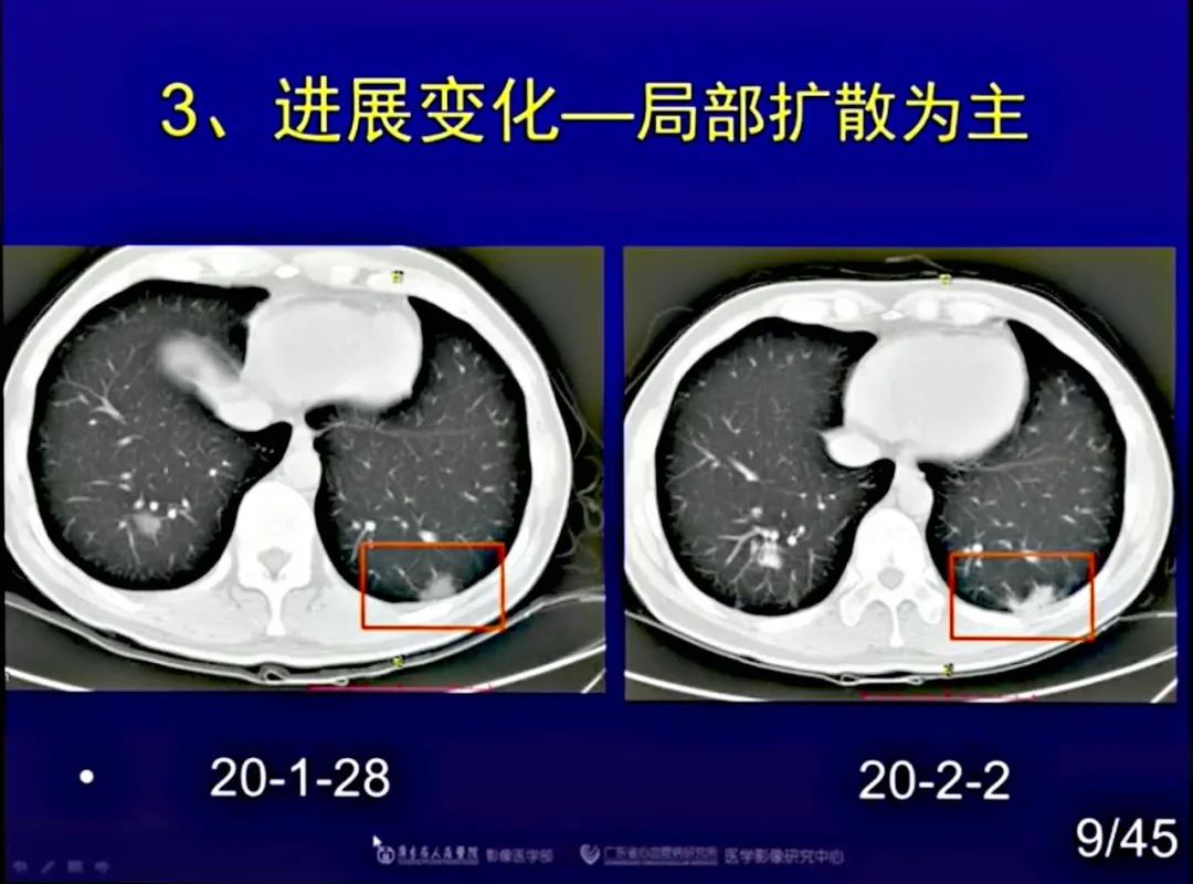 【PPT】新型冠状病毒感染CT早期诊断和鉴别诊断