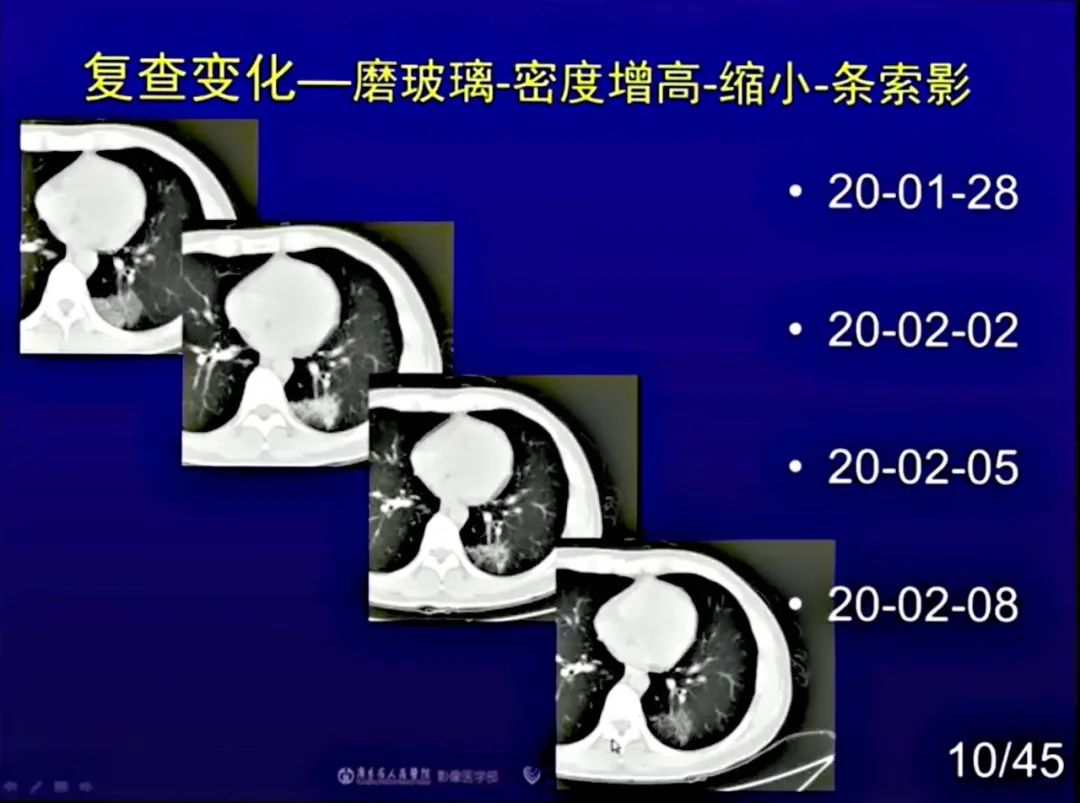 【PPT】新型冠状病毒感染CT早期诊断和鉴别诊断
