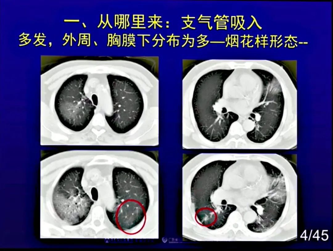 【PPT】新型冠状病毒感染CT早期诊断和鉴别诊断