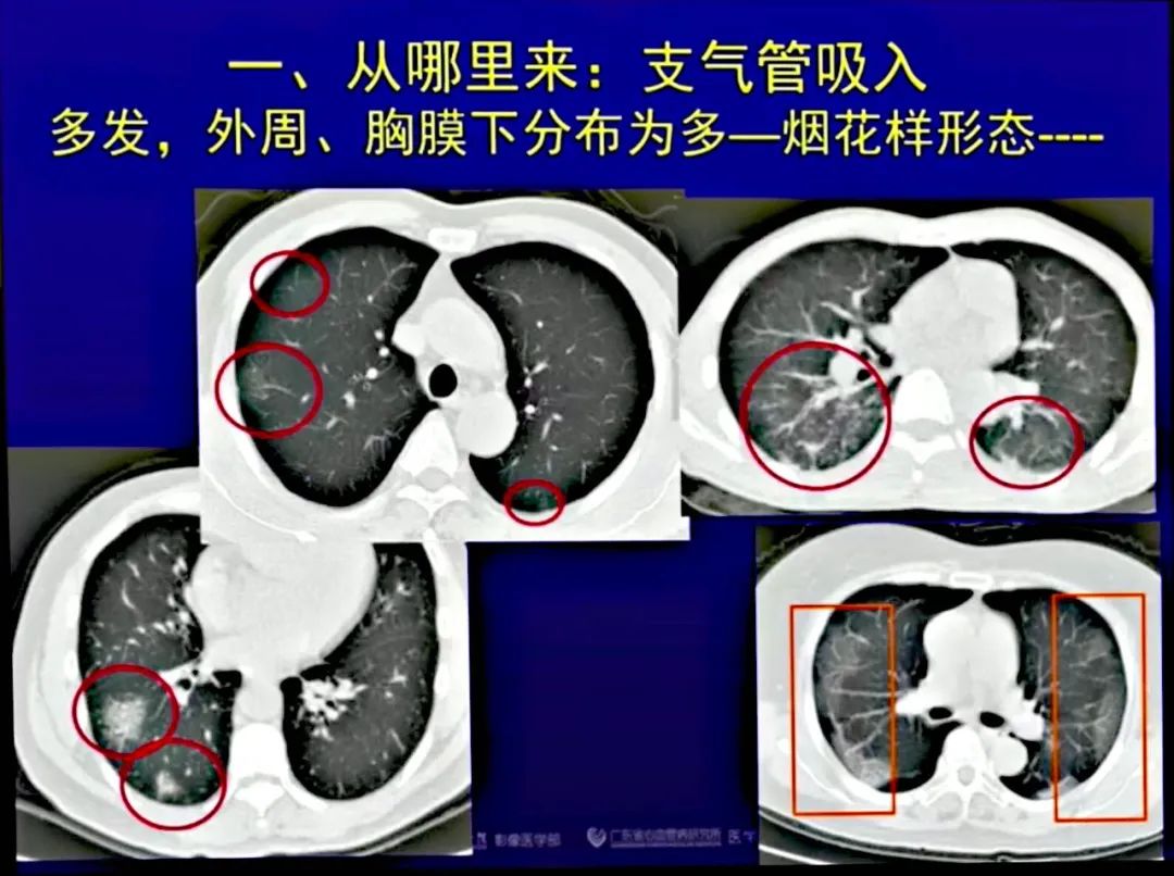 【PPT】新型冠状病毒感染CT早期诊断和鉴别诊断
