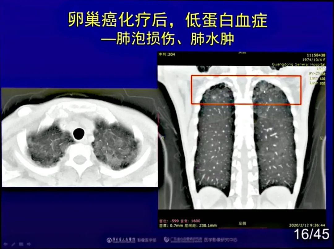 【PPT】新型冠状病毒感染CT早期诊断和鉴别诊断