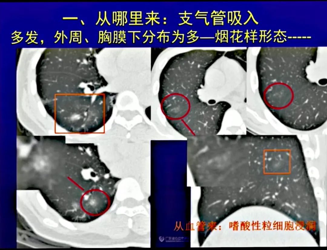 【PPT】新型冠状病毒感染CT早期诊断和鉴别诊断