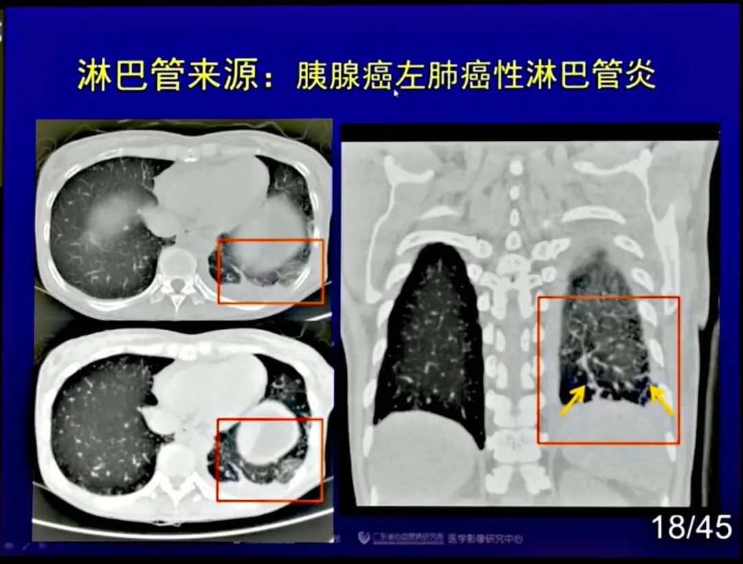【PPT】新型冠状病毒感染CT早期诊断和鉴别诊断