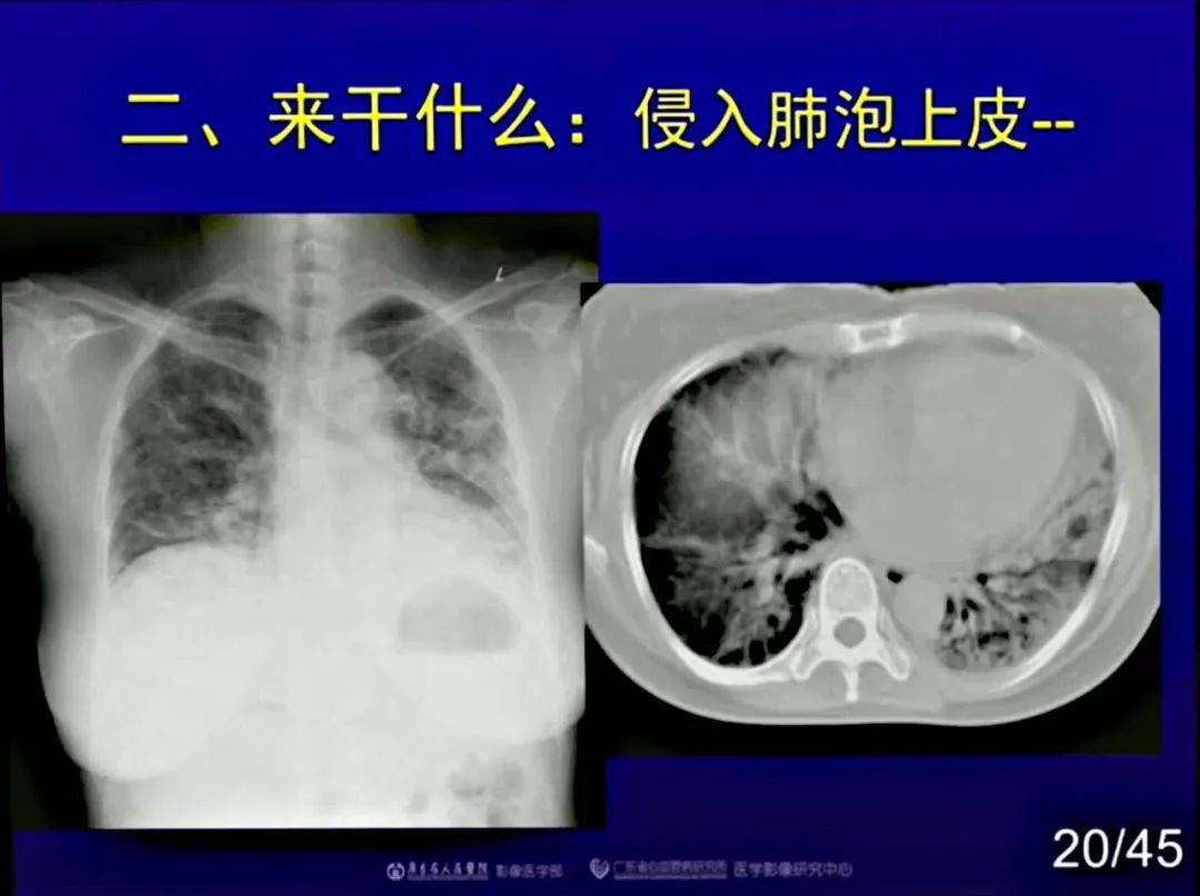 【PPT】新型冠状病毒感染CT早期诊断和鉴别诊断