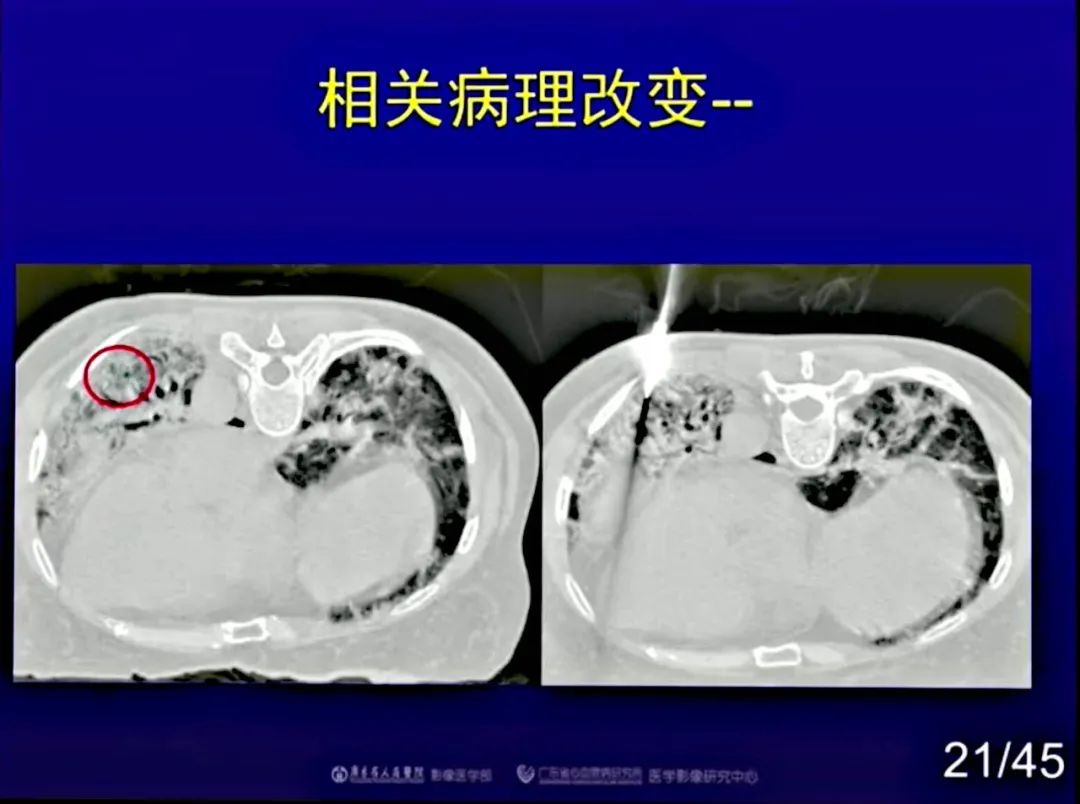 【PPT】新型冠状病毒感染CT早期诊断和鉴别诊断