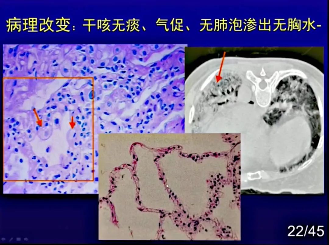 【PPT】新型冠状病毒感染CT早期诊断和鉴别诊断