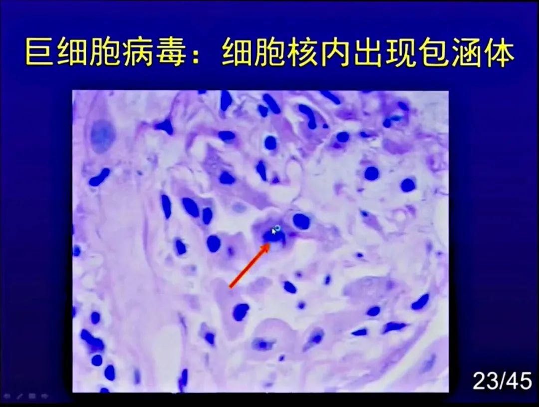 【PPT】新型冠状病毒感染CT早期诊断和鉴别诊断