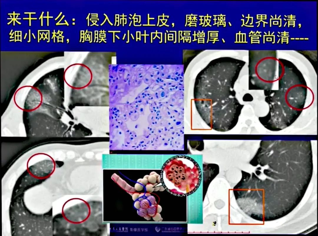 【PPT】新型冠状病毒感染CT早期诊断和鉴别诊断